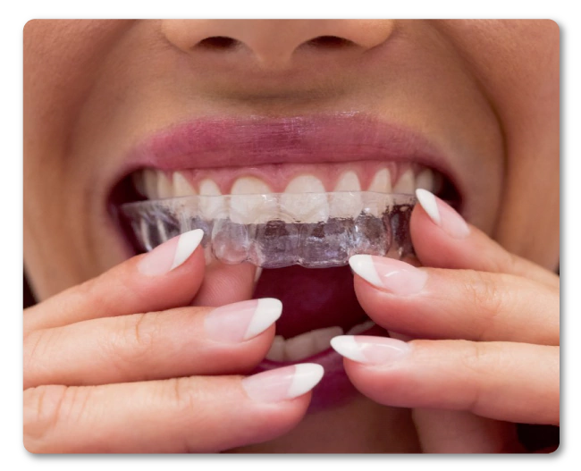 ORTODONCIA INVISIBLE | DentiSalud